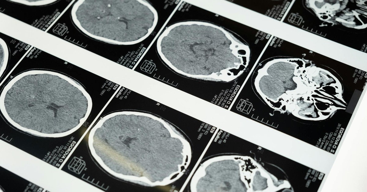 New Research Reveals Loss of Smell as Early Alzheimer’s Indicator Through Brain Immune Response
